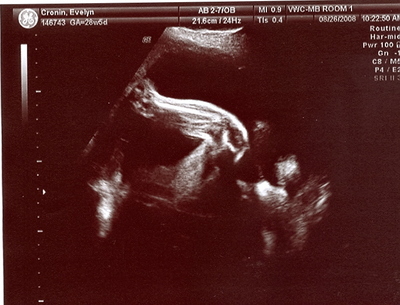 Bean left leg Aug 08